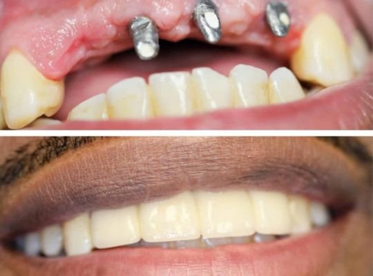 Dental implant treatment at Dhruv Dental Clinic in Ghatkopar West