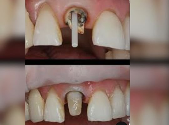 Post and core treatment at Dhruv Dental Clinic in Ghatkopar West