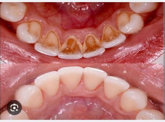 Teeth cleaning and polishing at Dhruv Dental Clinic Ghatkopar West