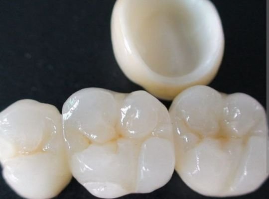 Zirconia caps and crowns at Dhruv Dental Clinic Ghatkopar West